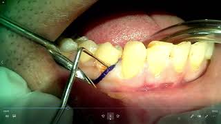 Gingival Retraction Cord Placement [upl. by Neehsuan]