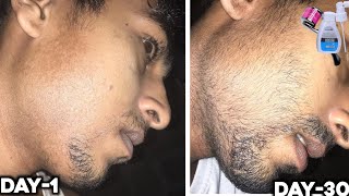 Mintop minoxidil से एक महीने में कितना दाढ़ी आएगा  minoxidil beard growth derma roller for beard [upl. by Natsud]