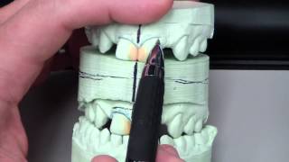 Diastema Closure  Dr Queso Discussion [upl. by Jet576]