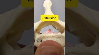 Cervical Disc Herniation Takes Time anatomy [upl. by Eagle]