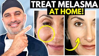 What you NEED to know about treating Melasma AT HOME the RIGHT way [upl. by Hadihahs511]