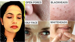 ಎಷ್ಟೇ ಹಳೆಯ OPEN PORES LARGE PORES CLOGGED PORES ಇದ್ದರು 100 ಹೋಗತ್ತೆ  Oily Skin  BLACKHEADS [upl. by Alli]