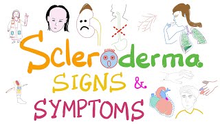 Scleroderma Pathogenesis and Clinical Manifestations Detailed Explanation [upl. by Nerin]