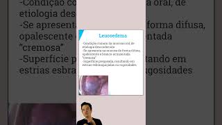 Características Clínicas do Leucoedema  Resumo Patologia Bucal  Concurso Odontologia [upl. by Nela]