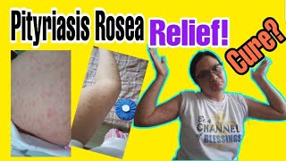 What is Pityriasis Rosea  My skin Condition [upl. by Gaby]