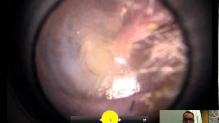 normal ear exam of the tympanic membrane [upl. by Anavas14]