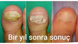 İleri Tırnak Mantarı Tedavisi Advanced Nail Fungus Treatment Istanbul [upl. by Highams]