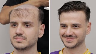 PROTEZ SAÇ  Hair Replacement [upl. by Nile]