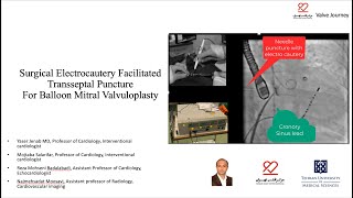 Surgical Electrocautery Facilitated Transseptal Percutaneous mitral balloon commissurotomy PMBC [upl. by Mattland338]