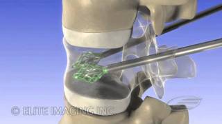 Vertebral Augmentation  Medical amp Scientific Video Production [upl. by Aikin]