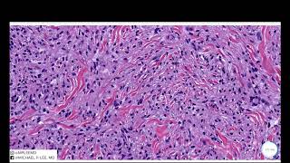 Juvenile Xanthogranuloma JXG Dermpath Made Easy [upl. by Rodolph]