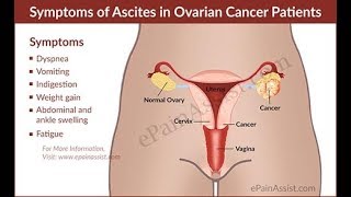 4 Common Symptoms Of Ascites [upl. by Letizia]