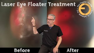 Treating the quotUntreatablequot VITREOUS EYE FLOATERS with YAG Laser [upl. by Lytle711]