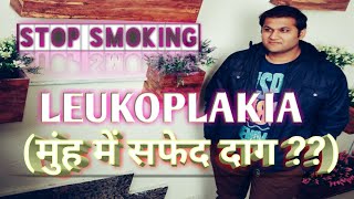 Leukoplakia Causes Symptoms Management amp Treatment  मुंह में सफेद और लाल दाग़ होना [upl. by Ahsinnek]