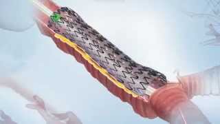 AERO® Fully Covered Tracheobronchial Stent Video [upl. by Merc38]