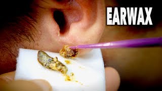 THE BEST EARWAX REMOVAL EVER and most gross  Dr Paul [upl. by Negah]