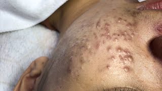 Blackheads Removal Acne Treatment Pimple Popping 18 [upl. by Ramoj]