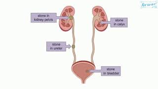 lithiasis [upl. by Ailisec783]