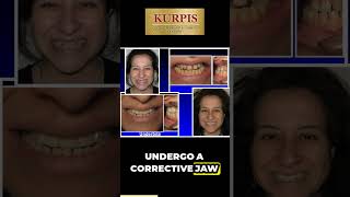 Underbite Correction Without Jaw Surgery [upl. by Jammal]