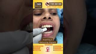 Aligner Tips  Inserting And Removing Aligners safely  Best Dental Hospital In Hyderabad  NDC [upl. by Elleneg619]