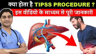 What is Transjugular Intrahepatic Portosystemic Shunt TIPS Procedure amp Used Cases [upl. by Sukey]