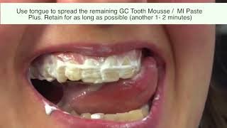 2 Methods to Use GC Tooth Mousse I Tooth Mousse Plus I MI Paste [upl. by Landre]