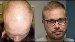 Full Head Restoration  7 Months Later With Stewart [upl. by Ermine]