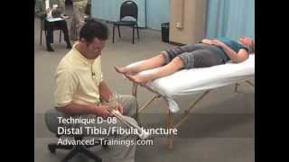 Ankle FibulaTibia Syndesmosis  Advanced Myofascial Techniques DVD Series [upl. by Genovera508]