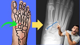 Lisfranc Injury Can it be fixed with an ANKLE TIGHTROPE [upl. by Zeeba]