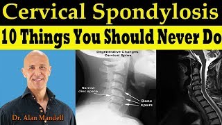 CERVICAL SPONDYLOSIS 10 Things You Should Never Do  Dr Alan Mandell DC [upl. by Colfin]