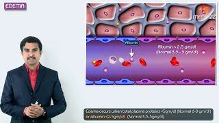 1Edema introduction  Hemodynamic pathology Fmge Neet PG and usmle [upl. by Eugenle243]