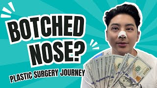 BOTCHED NOSE  Plastic Surgery Journey [upl. by Goles]