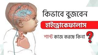 How will you understand is VP shut functioning or not  Best Pediatric Neurosurgeon in Bangladesh [upl. by Persis]