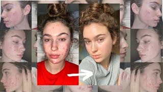 I Filmed My Entire Accutane Journey  QampA Tips Skincare [upl. by Eekaz]