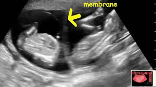 Monochorionic Twins at 9 Weeks Ultrasound Cases [upl. by Cadal]