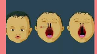 What cause Of cleft lip and cleft palate in Baby After Birth  Symptoms and Treatment [upl. by Elinor]