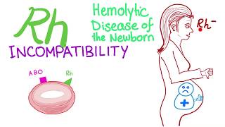 Rh incompatibility and Hemolytic disease of the newborn HDN [upl. by Kamila]