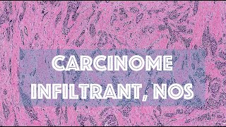 LE CARCINOME INFILTRANT DU SEIN DE TYPE NON SPECIFIQUE  PATHOLOGIE [upl. by Shurlocke]