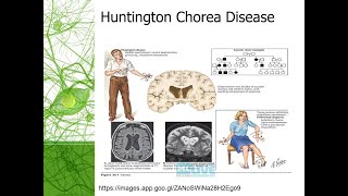 Huntington Chorea Disease  A neurodegenrative genetic disease [upl. by Leahciam525]