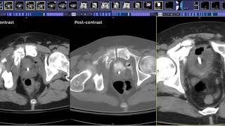 How to read a CT Cystogram [upl. by Lightman]