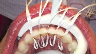 Retanium Splint Placement Orthodontics [upl. by Wilfreda]