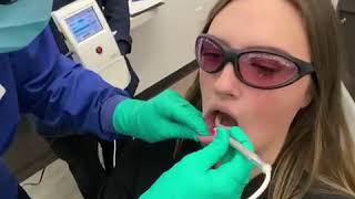 Laser treatment for cold sores and canker sores [upl. by Thetos]