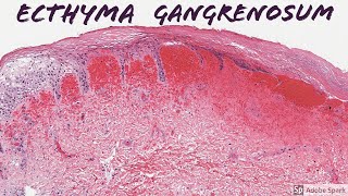 Ecthyma Gangrenosum 5Minute Pathology Pearls [upl. by Etnoled]