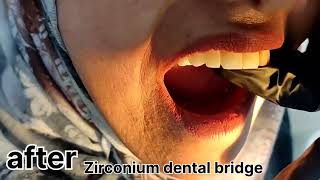 zirconia crowns dental bridge before and after [upl. by Corie]