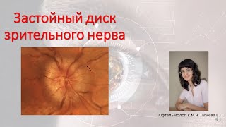 Застойный диск зрительного нерва Причины классификация дифференциальный диагноз [upl. by York]