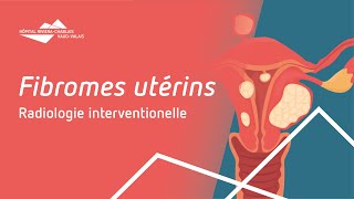 Les fibromes utérins et leur traitement par embolisation [upl. by Georgetta846]