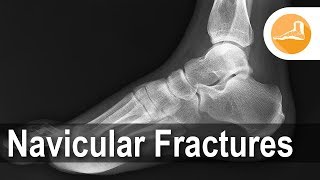 Navicular Fractures with Dr Erik Nilssen [upl. by Nichol642]