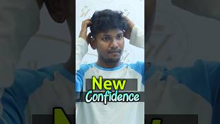 Best Hair Transplant Result in India 😍 hairtransplantresults hairtransplant shorts [upl. by Cenac159]