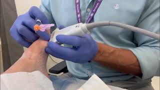 Sesamoid injection for osteoarthritis [upl. by Lyrred]