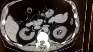 CT scan for kidney stone [upl. by Brass]